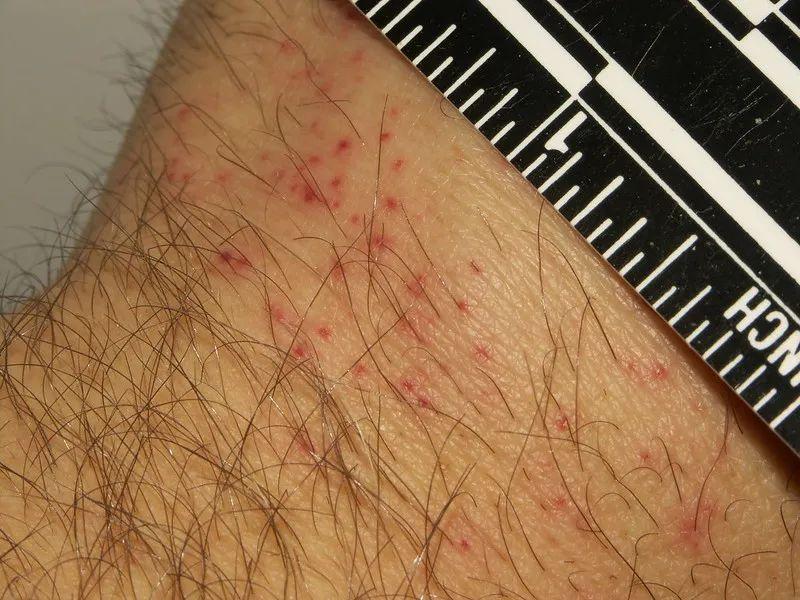 怎么灭床上臭虫_床上杀臭虫的喷什么药_床臭虫